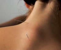 Acupuncture and Shiatsu at Triangle Therapies 726617 Image 1